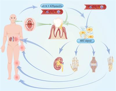 Recent progress and perspectives on the relationship between hyperuricemia and periodontitis